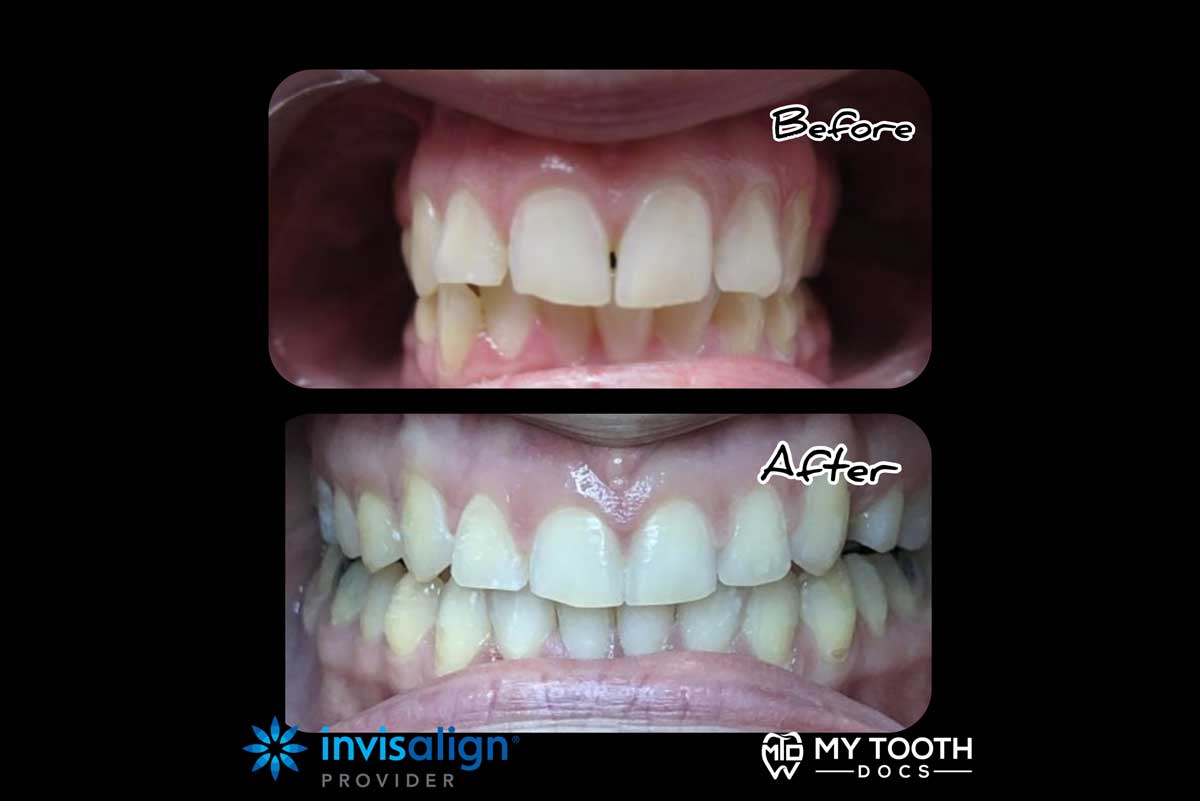 my-tooth-docs-slider-before-after-1200x800