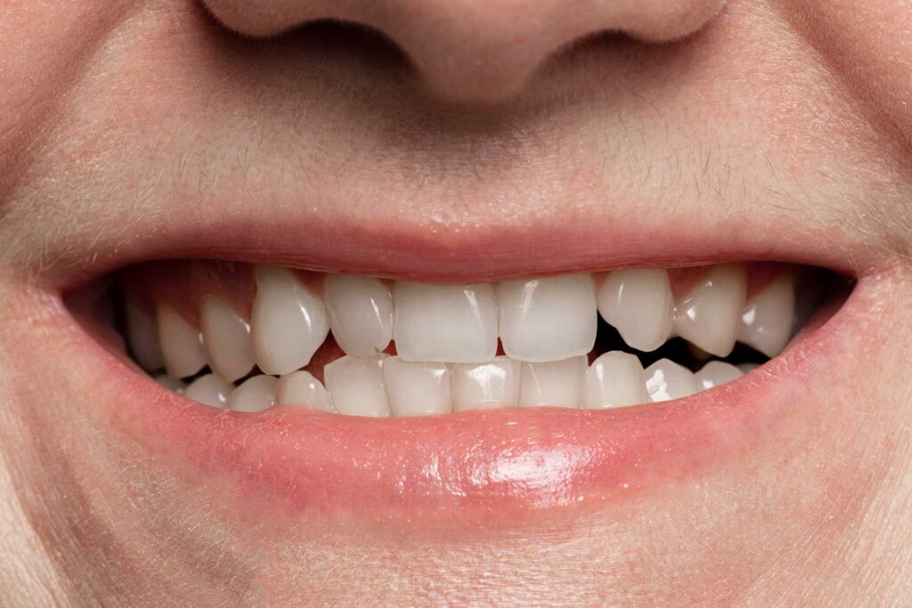 Teeth Whitening in Naperville & South Holland