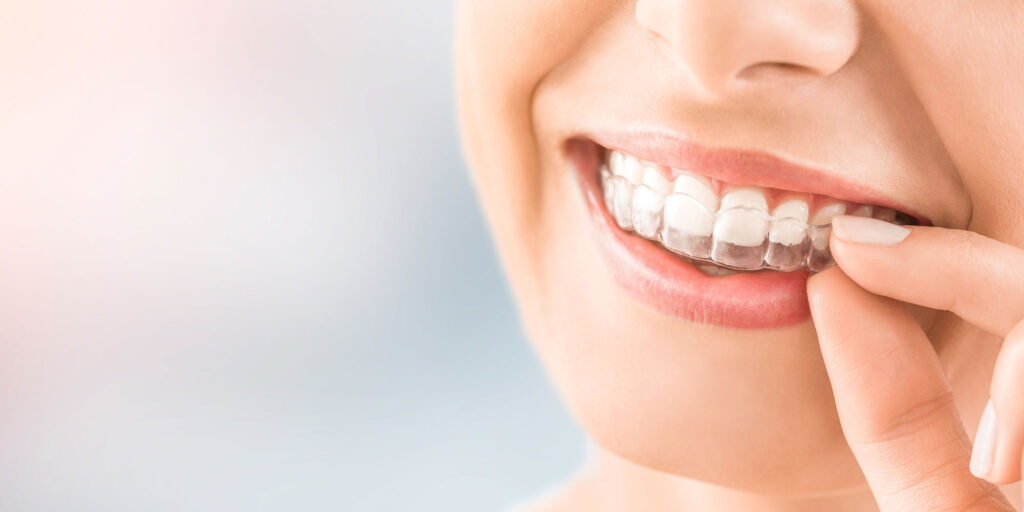 Invisalign in Naperville & South Holland