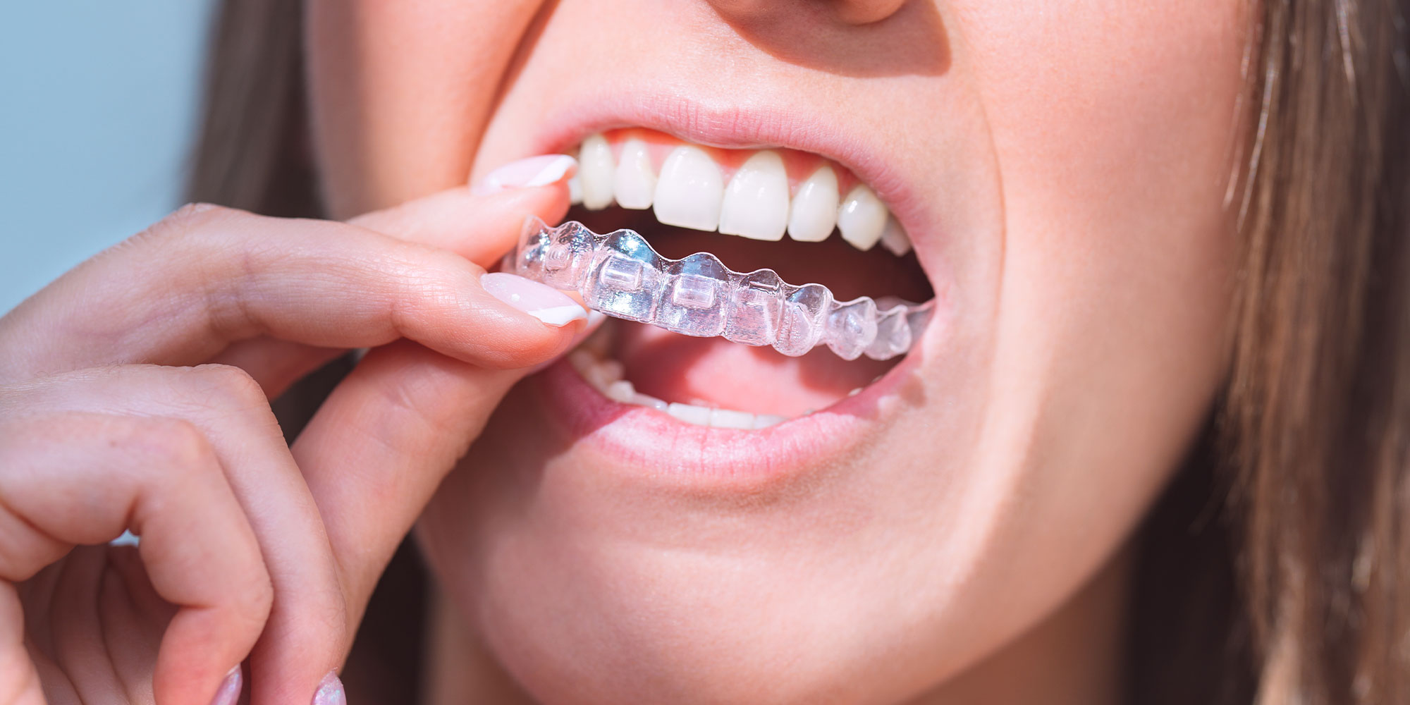 Invisalign