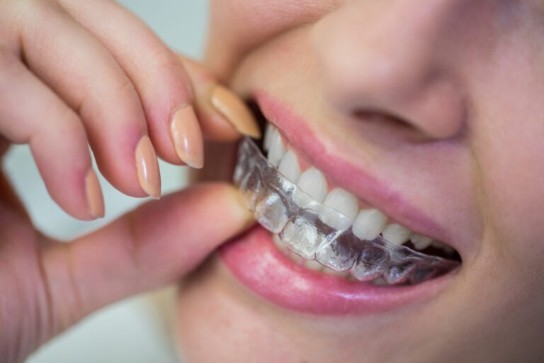 What Can Invisalign Fix? Overbite, Crowding, Gaps & More