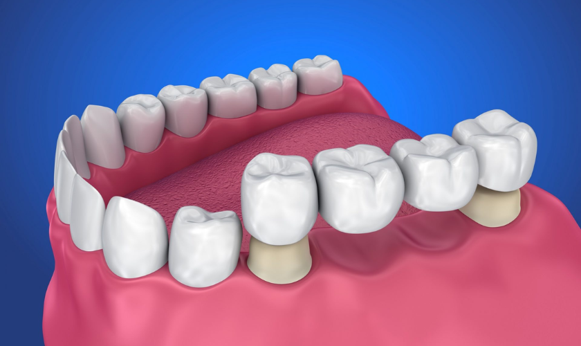 Are-Dental-Bridges-Right-for-You