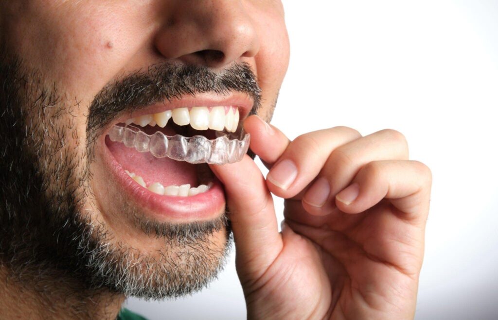 Man placing a clear Invisalign aligner over his teeth
