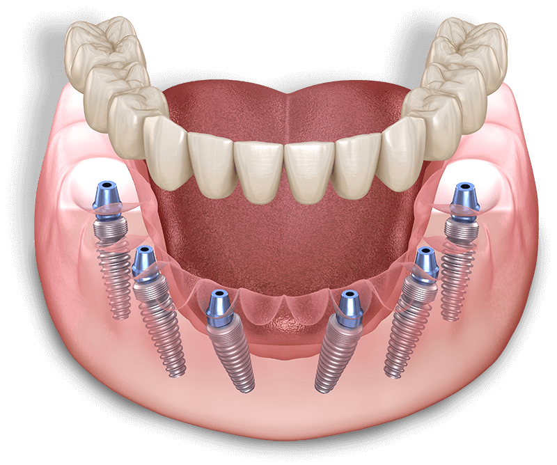 Dental Implant