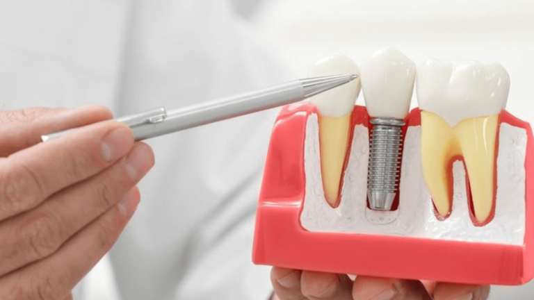 How Much Do Dental Implants Cost in Naperville?