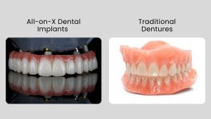 Dentures Vs Implants