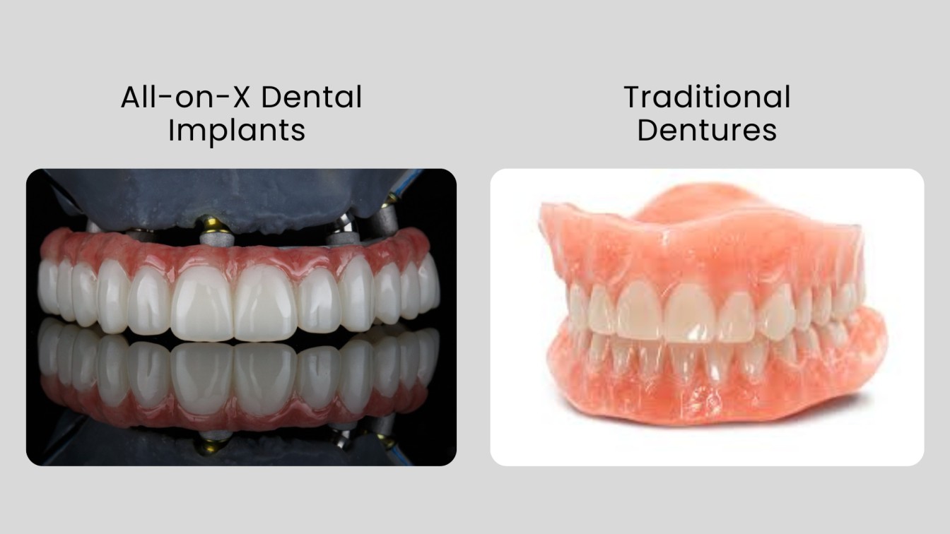 Dentures Vs Implants