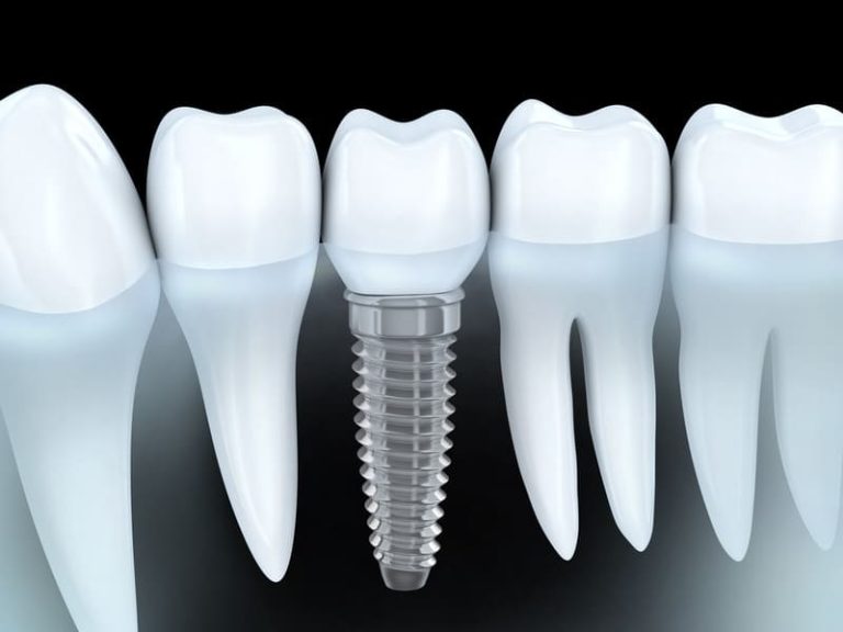 Dentist explaining full mouth dental implants with a model in Naperville