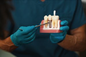 Dental Implant Procedure
