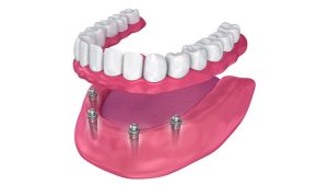 Snap On Dentures