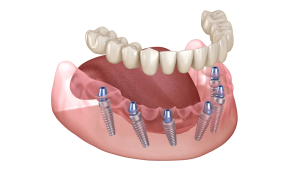 All On X Dental Implants