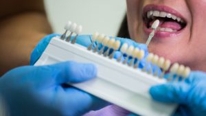 Veneers