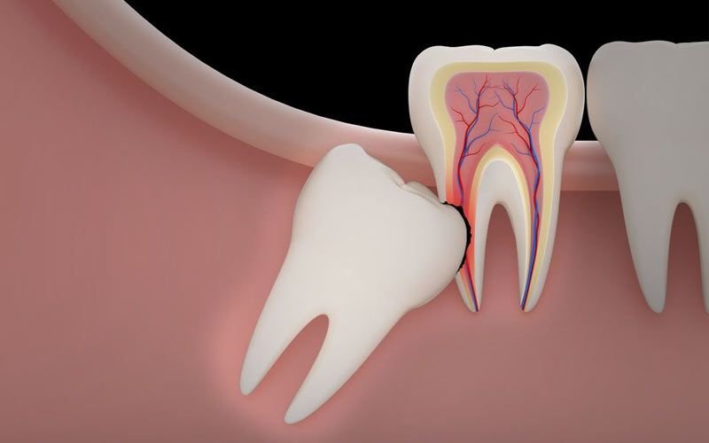 Wisdom Teeth Removal