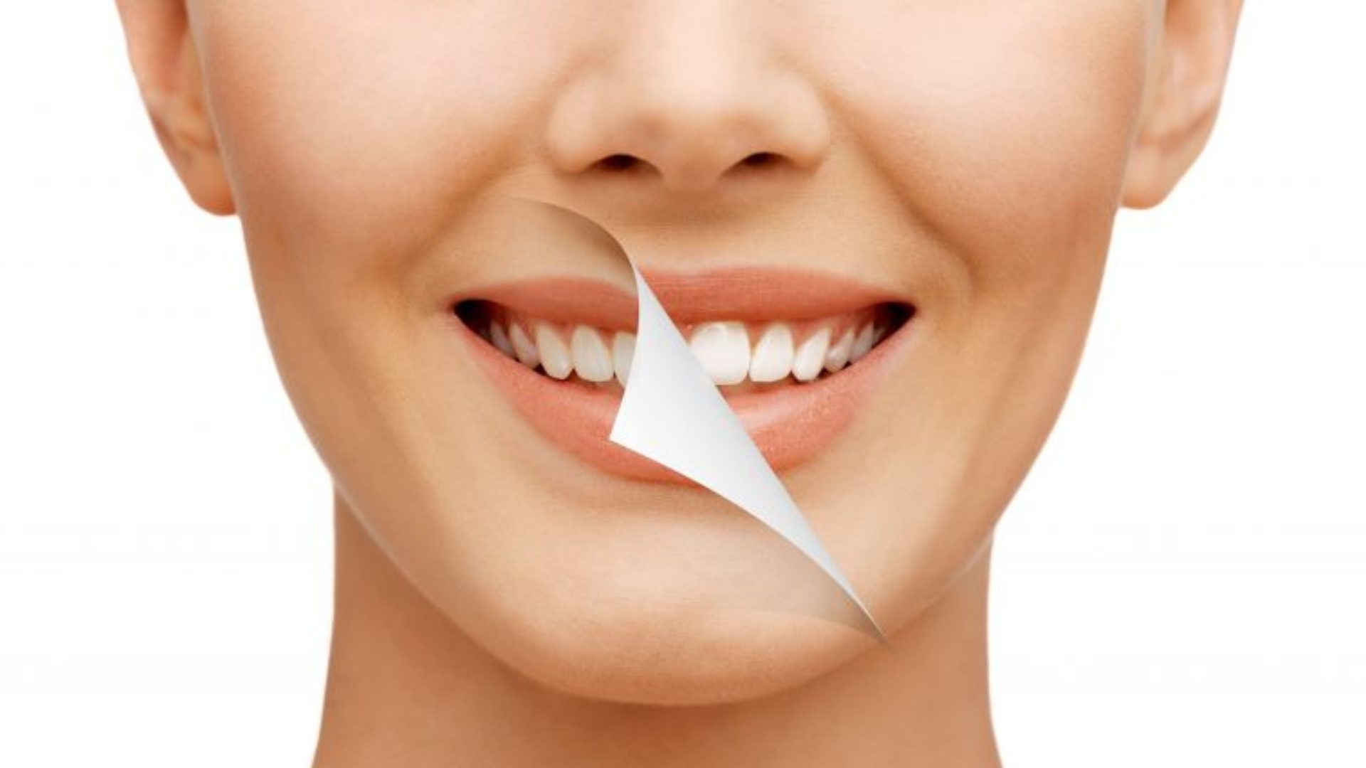 Teeth Whitening