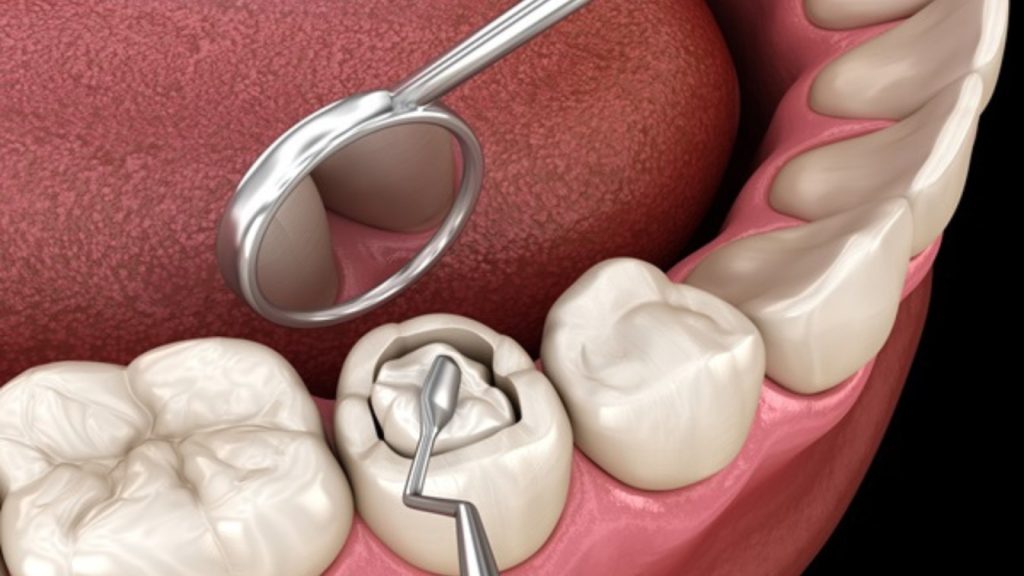 Root Canal