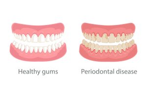 Gum Disease