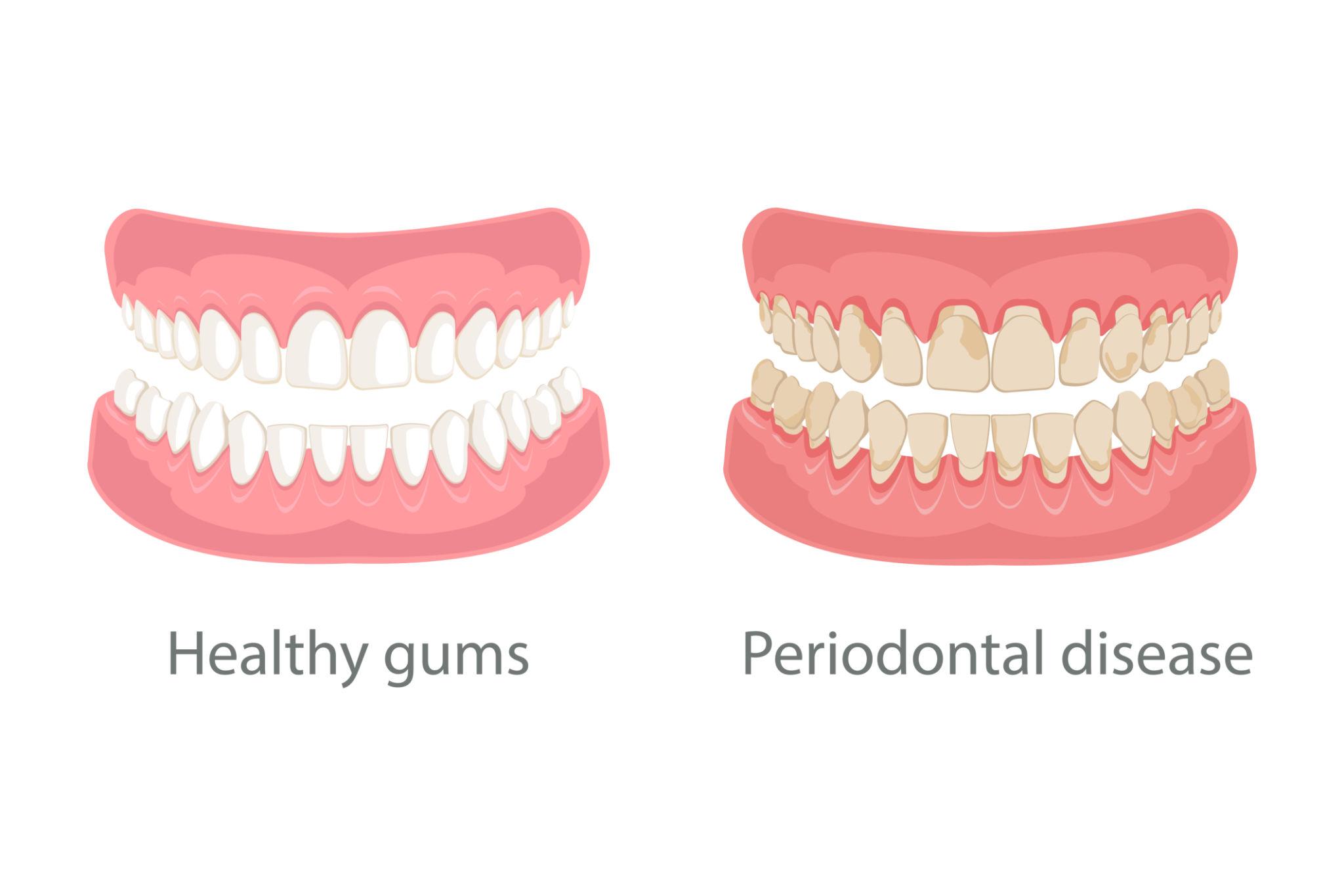 Gum Disease